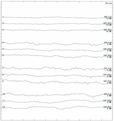 Case Report: Novel Arylsulfatase A (ARSA) Gene Mutations in a Patient With Adult-Onset Metachromatic Leukodystrophy Misdiagnosed as Multiple Sclerosis